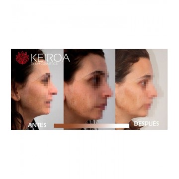 Keiroa k-white crema facial despigmentante anti manchas